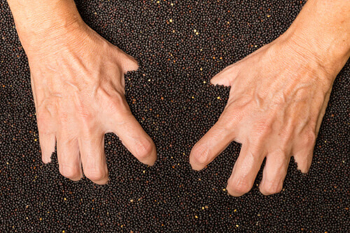 Ergotherapie in der Rheumatologie